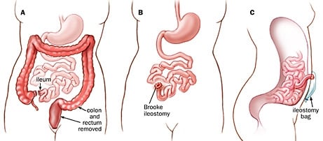 Ileostomies