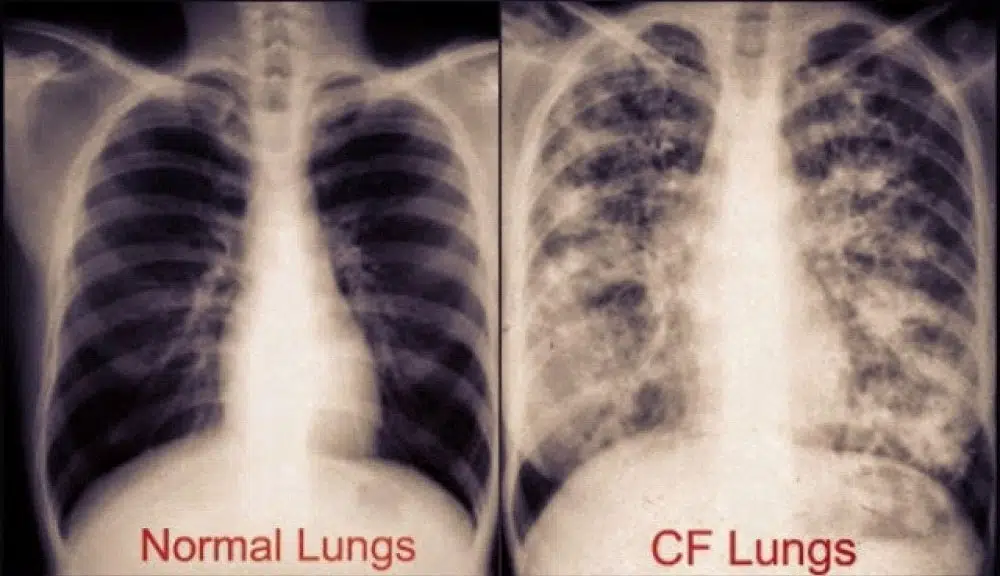 Cystic Fibrosis